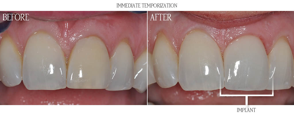 tooth implant before after