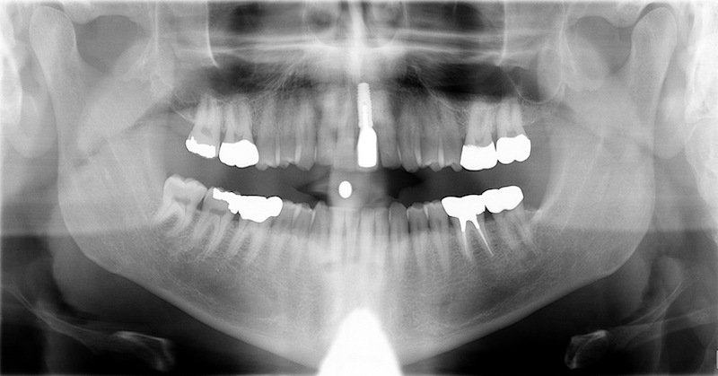 Can Diabetics Get Dental Implants?: A Comprehensive Guide