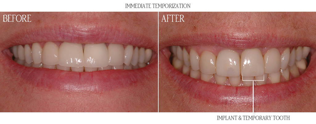 The surgeon extracted the maxillary left central incisor and placed a dental implant with a bone graft. That same day, the dentist placed a zirconium abutment and a temporary restoration. After three months of implant healing, the dentist replaced the temporary restoration with porcelain fused to zirconia restoration. The surgeon extracted the maxillary left central incisor and placed a dental implant with a bone graft. That same day, the dentist placed a zirconium abutment and a temporary restoration. After three months of implant healing, the dentist replaced the temporary restoration with porcelain fused to zirconia restoration.