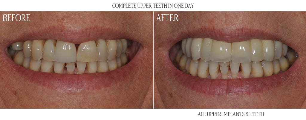 The surgeon removed all remaining upper teeth and placed six dental implants with bone grafts. That same day the dentist attached temporary teeth to the dental implants. After three months of implant healing, the dentist replaced the temporary teeth with a metal ceramic fixed restoration. The surgeon removed all remaining upper teeth and placed six dental implants with bone grafts. That same day the dentist attached temporary teeth to the dental implants. After three months of implant healing, the dentist replaced the temporary teeth with a metal ceramic fixed restoration.