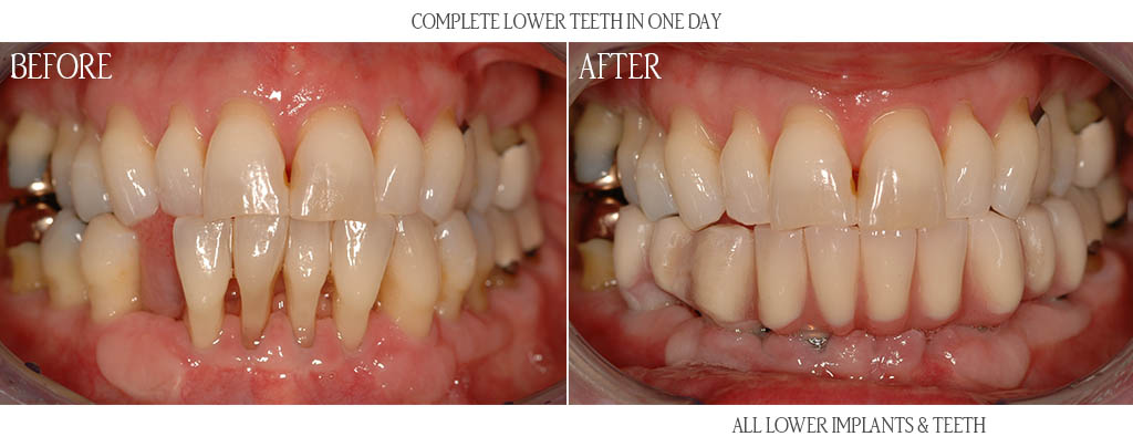 The surgeon removed all remaining lower teeth except the lower second molars and placed six dental implants with bone grafts. That same day the dentist attached temporary teeth to the dental implants. After three months of implant healing, the dentist replaced the temporary teeth with a fixed lower hybrid restoration. The surgeon removed all remaining lower teeth except the lower second molars and placed six dental implants with bone grafts. That same day the dentist attached temporary teeth to the dental implants. After three months of implant healing, the dentist replaced the temporary teeth with a fixed lower hybrid restoration.