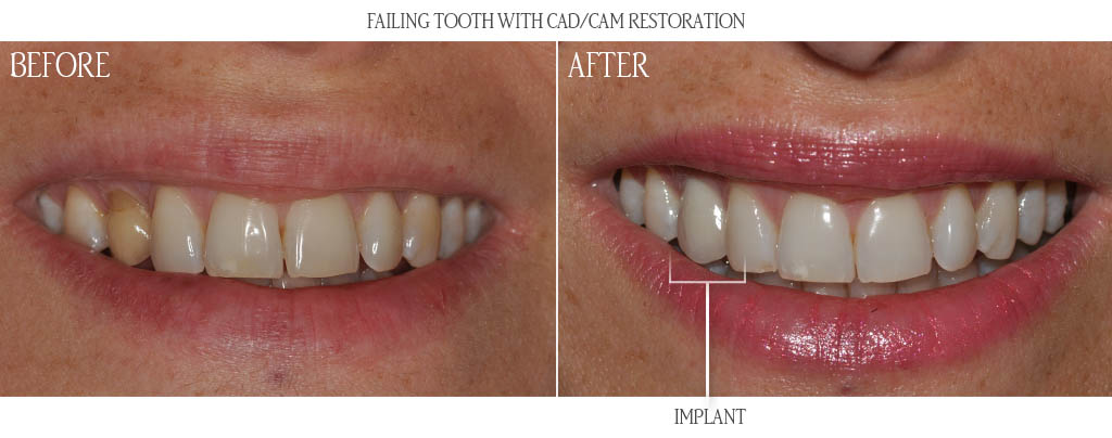 These are the CAD/CAM design images of a mandibular first molar and porcelain fused to zirconia restoration. These are the CAD/CAM design images of a mandibular first molar and porcelain fused to zirconia restoration.