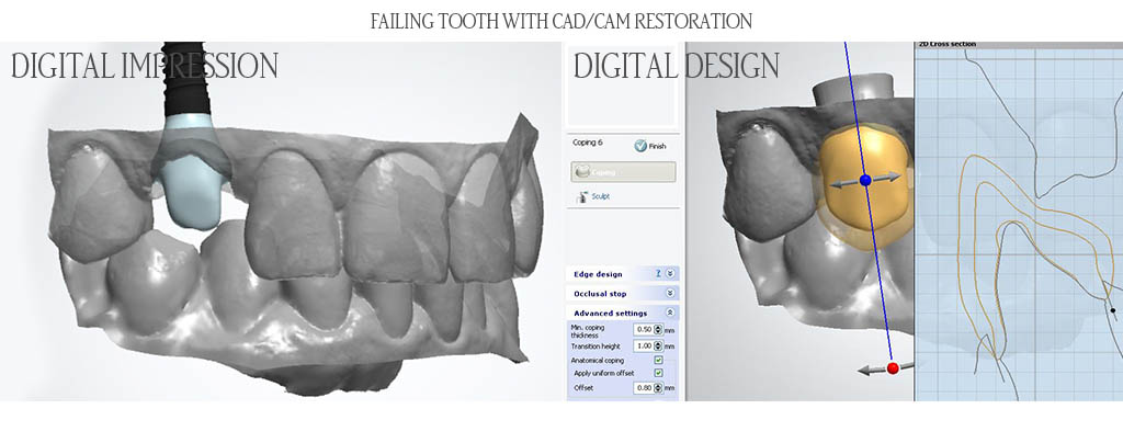 The surgeon extracted the lower right first molar and placed a dental implant with a bone graft. After three months of implant healing, the dentist placed a custom titanium abutment and porcelain fused to zirconia restoration. The surgeon extracted the lower right first molar and placed a dental implant with a bone graft. After three months of implant healing, the dentist placed a custom titanium abutment and porcelain fused to zirconia restoration.