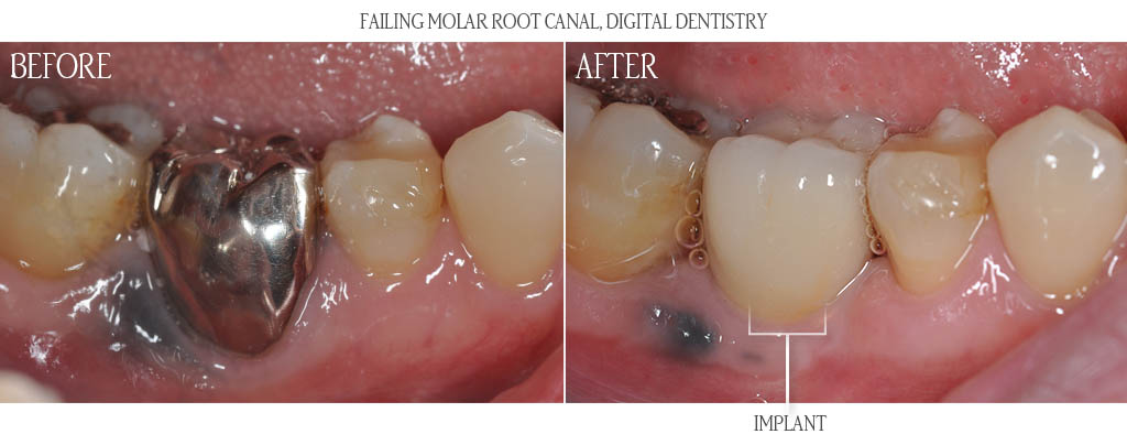 The surgeon removed the maxillary right primary (baby) tooth and placed a dental implant with a bone graft. After three months of implant healing, a digital impression was obtained and the dentist designed the abutment and restoration using CAD technology. The titanium custom abutment was manufactured using CAM technology and delivered in a one-appointment visit. The restoration is porcelain fused to zirconia. The surgeon removed the maxillary right primary (baby) tooth and placed a dental implant with a bone graft. After three months of implant healing, a digital impression was obtained and the dentist designed the abutment and restoration using CAD technology. The titanium custom abutment was manufactured using CAM technology and delivered in a one-appointment visit. The restoration is porcelain fused to zirconia.