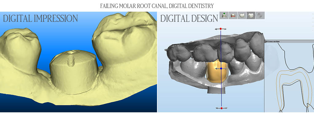 These are the CAD/CAM design images of a maxillary right canine. These are the CAD/CAM design images of a maxillary right canine.
