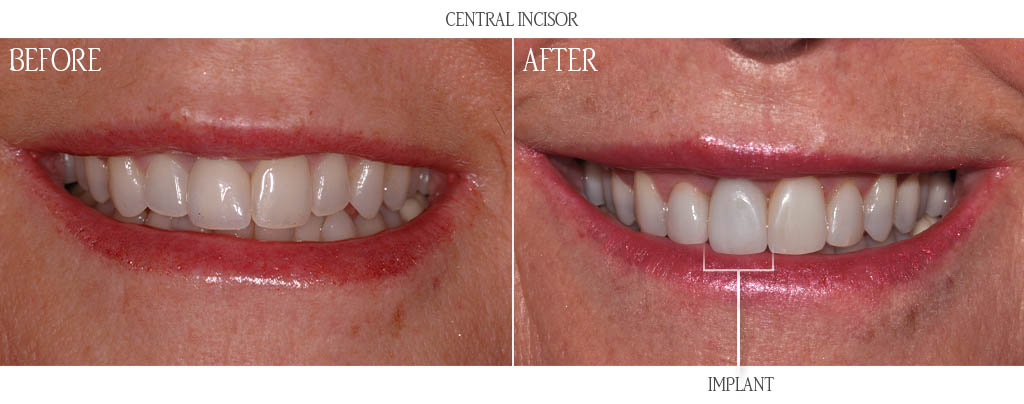 The surgeon removed the maxillary right central incisor and placed a dental implant with a bone graft. That same day, the dentist attached a temporary tooth to the dental implant. After three months of healing, the dentist placed a zirconium abutment and a lithium disilicate restoration. The surgeon removed the maxillary right central incisor and placed a dental implant with a bone graft. That same day, the dentist attached a temporary tooth to the dental implant. After three months of healing, the dentist placed a zirconium abutment and a lithium disilicate restoration.