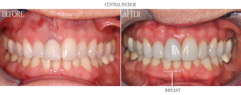 The surgeon removed the maxillary right central incisor and placed a dental implant with a bone graft. That same day, the dentist attached a temporary tooth to the dental implant. After three months of healing, the dentist placed a zirconium abutment and a lithium disilicate restoration. The surgeon removed the maxillary right central incisor and placed a dental implant with a bone graft. That same day, the dentist attached a temporary tooth to the dental implant. After three months of healing, the dentist placed a zirconium abutment and a lithium disilicate restoration.