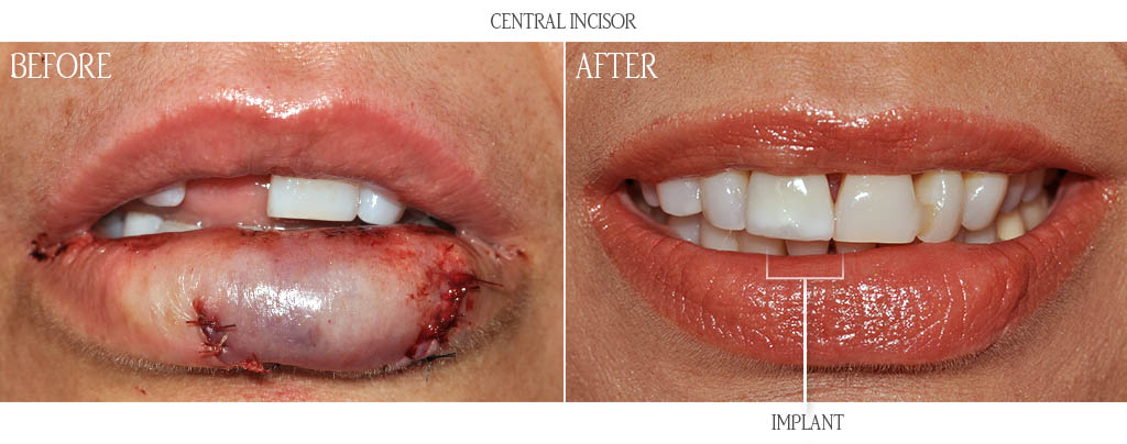 The patient presented with a fractured maxillary right central incisor and fractured maxilla and lower lip laceration after a fall. The surgeon closed the lip laceration, removed the fractured tooth, placed a dental implant and reconstructed the buccal plate with a bone graft. After three months of healing, the dentist placed a custom abutment and a temporary acrylic tooth. The patient presented with a fractured maxillary right central incisor and fractured maxilla and lower lip laceration after a fall. The surgeon closed the lip laceration, removed the fractured tooth, placed a dental implant and reconstructed the buccal plate with a bone graft. After three months of healing, the dentist placed a custom abutment and a temporary acrylic tooth.