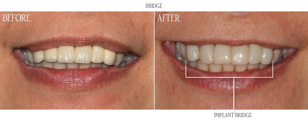 An implant bridge from seven to ten replaced a failing natural tooth bridge on teeth seven and ten. The surgeon removed teeth seven and ten and placed implants into the extraction sockets with bone grafts. After 3 months of implant healing, the dentist placed an implant bridge from seven to ten on dental implants seven and ten. An implant bridge from seven to ten replaced a failing natural tooth bridge on teeth seven and ten. The surgeon removed teeth seven and ten and placed implants into the extraction sockets with bone grafts. After 3 months of implant healing, the dentist placed an implant bridge from seven to ten on dental implants seven and ten.