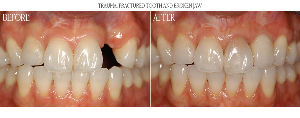 A maxillary alveolar fracture and avulsed tooth resulted in a large defect. The surgeon corrected the defect with a block autogenous onlay bone graft. After three months of graft healing, an implant was placed with a soft tissue graft. After three months of implant healing, the restorative dentist placed a custom abutment with porcelain fused to metal restoration. A maxillary alveolar fracture and avulsed tooth resulted in a large defect. The surgeon corrected the defect with a block autogenous onlay bone graft. After three months of graft healing, an implant was placed with a soft tissue graft. After three months of implant healing, the restorative dentist placed a custom abutment with porcelain fused to metal restoration.