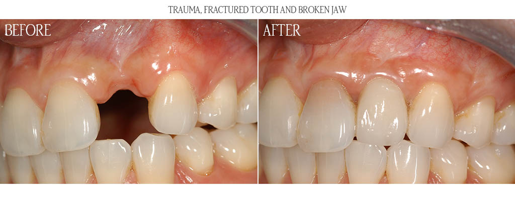 A maxillary alveolar fracture and avulsed tooth resulted in a large defect. The surgeon corrected the defect with a block autogenous onlay bone graft. After 3 months of graft healing, an implant was placed with a soft tissue graft. After three months of implant healing, the restorative dentist placed a custom gold cast abutment with porcelain fused to metal restoration. A maxillary alveolar fracture and avulsed tooth resulted in a large defect. The surgeon corrected the defect with a block autogenous onlay bone graft. After 3 months of graft healing, an implant was placed with a soft tissue graft. After three months of implant healing, the restorative dentist placed a custom gold cast abutment with porcelain fused to metal restoration.