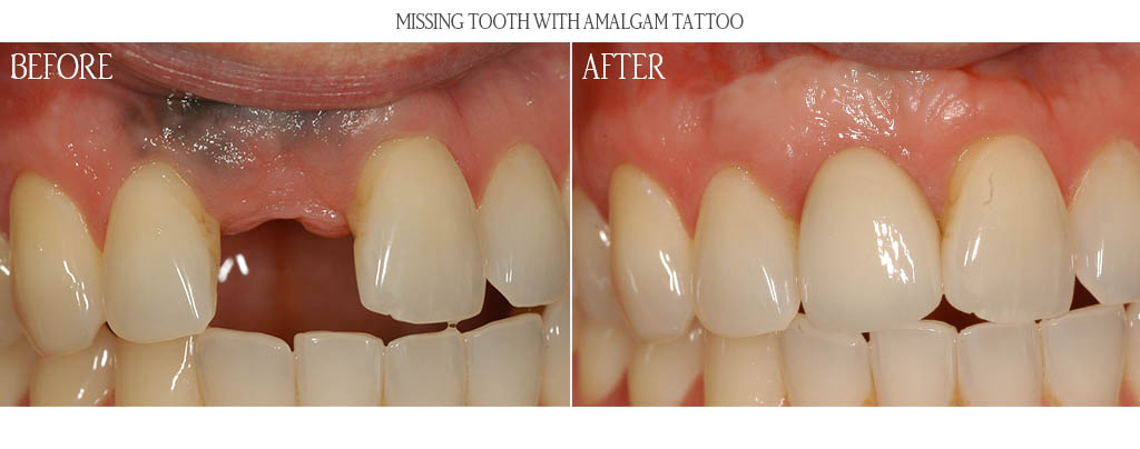The surgeon removed the amalgam tattoo and placed an epithelial graft and a connective tissue graft. After two months of healing, the surgeon placed a dental implant with a bone graft. After three months of implant healing, a custom titanium abutment was placed with porcelain fused to metal restoration. The surgeon removed the amalgam tattoo and placed an epithelial graft and a connective tissue graft. After two months of healing, the surgeon placed a dental implant with a bone graft. After three months of implant healing, a custom titanium abutment was placed with porcelain fused to metal restoration.