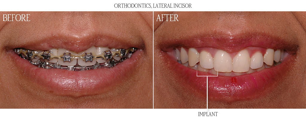 The orthodontist established proper restorative spacing for a dental implant replacing a congenitally missing maxillary lateral incisor. The surgeon then placed a dental implant with a bone graft. After three months of implant healing, the braces were removed and the dentist placed a custom zirconia abutment with a porcelain ceramic restoration and porcelain veneer restoration on the right central and lateral incisors correcting proportions and spaces. The orthodontist established proper restorative spacing for a dental implant replacing a congenitally missing maxillary lateral incisor. The surgeon then placed a dental implant with a bone graft. After three months of implant healing, the braces were removed and the dentist placed a custom zirconia abutment with a porcelain ceramic restoration and porcelain veneer restoration on the right central and lateral incisors correcting proportions and spaces.