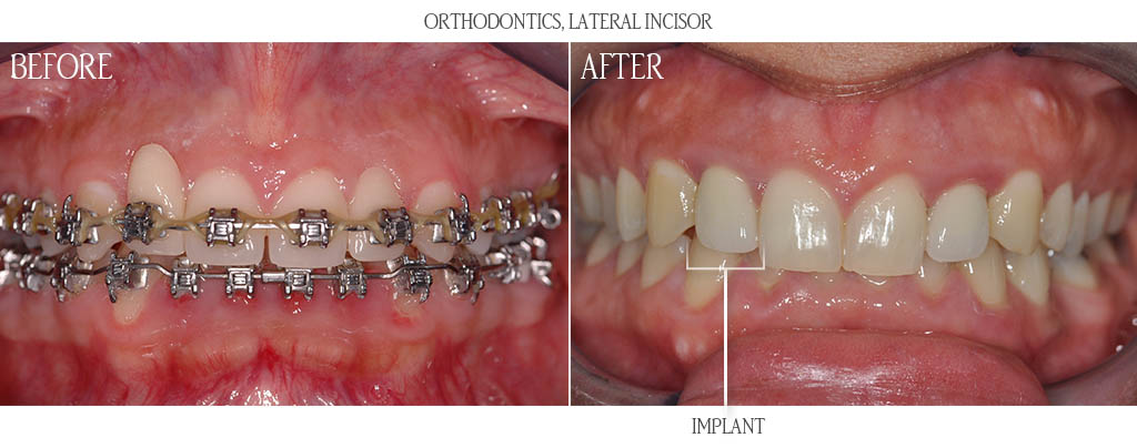 The orthodontist established proper restorative spacing for a dental implant replacing a congenitally missing maxillary lateral incisor. The surgeon then placed a dental implant with a bone graft. After three months of implant healing, the braces were removed and the dentist placed a custom titanium abutment with a lithium disilicate restoration. The orthodontist established proper restorative spacing for a dental implant replacing a congenitally missing maxillary lateral incisor. The surgeon then placed a dental implant with a bone graft. After three months of implant healing, the braces were removed and the dentist placed a custom titanium abutment with a lithium disilicate restoration.