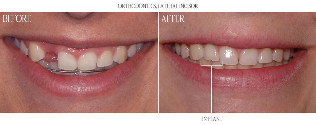 The orthodontist established proper restorative spacing for a dental implant replacing a congenitally missing maxillary lateral incisor. The surgeon then placed a dental implant with a bone graft. After three months of implant healing, the braces were removed and the dentist placed a custom titanium abutment with porcelain fused to metal restoration. The orthodontist established proper restorative spacing for a dental implant replacing a congenitally missing maxillary lateral incisor. The surgeon then placed a dental implant with a bone graft. After three months of implant healing, the braces were removed and the dentist placed a custom titanium abutment with porcelain fused to metal restoration.