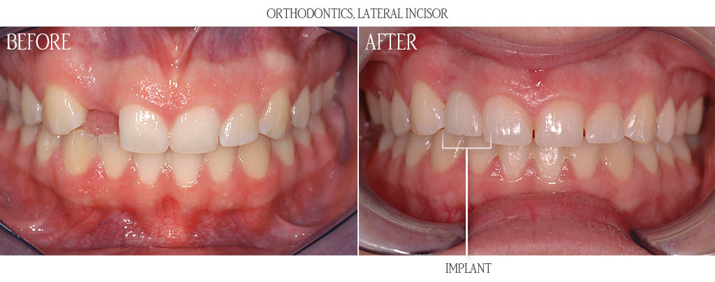 The orthodontist established proper restorative spacing for a dental implant replacing a congenitally missing maxillary lateral incisor. The surgeon then placed a dental implant with a bone graft. After three months of implant healing, the braces were removed and the dentist placed a custom titanium abutment with porcelain fused to metal restoration. The orthodontist established proper restorative spacing for a dental implant replacing a congenitally missing maxillary lateral incisor. The surgeon then placed a dental implant with a bone graft. After three months of implant healing, the braces were removed and the dentist placed a custom titanium abutment with porcelain fused to metal restoration.