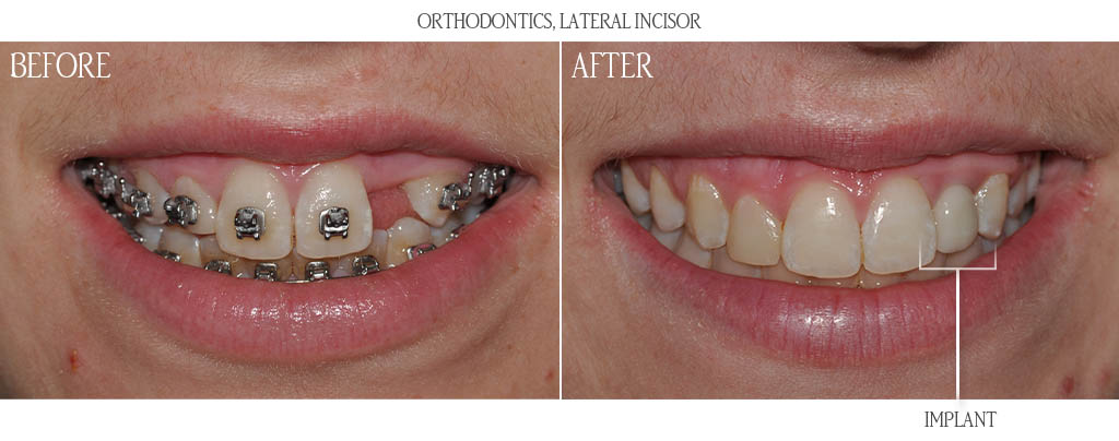The orthodontist established proper restorative spacing for a dental implant replacing a congenitally missing maxillary lateral incisor. The braces were removed and when the patient was age appropriate for a dental implant, the surgeon placed the dental implant with a bone graft. After three months of implant healing, the dentist placed a custom titanium gold abutment with a metal ceramic restoration. The orthodontist established proper restorative spacing for a dental implant replacing a congenitally missing maxillary lateral incisor. The braces were removed and when the patient was age appropriate for a dental implant, the surgeon placed the dental implant with a bone graft. After three months of implant healing, the dentist placed a custom titanium gold abutment with a metal ceramic restoration.