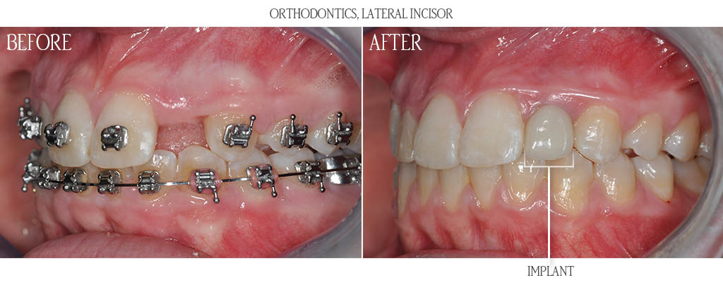 The orthodontist established proper restorative spacing for a dental implant replacing a congenitally missing maxillary lateral incisor. The braces were removed and when the patient was age appropriate for a dental implant, the surgeon placed the dental implant with a bone graft. After three months of implant healing, the dentist placed a custom titanium gold abutment with a metal ceramic restoration. The orthodontist established proper restorative spacing for a dental implant replacing a congenitally missing maxillary lateral incisor. The braces were removed and when the patient was age appropriate for a dental implant, the surgeon placed the dental implant with a bone graft. After three months of implant healing, the dentist placed a custom titanium gold abutment with a metal ceramic restoration.