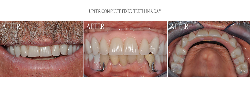 All upper and lower teeth were determined to be non-restorable. The surgeon extracted all upper and lower teeth, placed 6 upper and 6 lower dental implants with minor bone grafting and attached temporary teeth in the same day. After 3 months of implant healing, the dentist designed and fabricated a complete set of teeth attached to the implants. The teeth are not removable by the patient. All upper and lower teeth were determined to be non-restorable. The surgeon extracted all upper and lower teeth, placed 6 upper and 6 lower dental implants with minor bone grafting and attached temporary teeth in the same day. After 3 months of implant healing, the dentist designed and fabricated a complete set of teeth attached to the implants. The teeth are not removable by the patient.