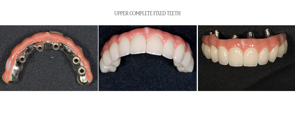 All upper teeth were determined to be non-restorable. The surgeon extracted all upper teeth, placed 6 dental implants and attached teeth to the implants with minor bone grafting. After 3 months of implant healing, the dentist designed and fabricated a complete set of teeth attached to the implants. The teeth are not removable by the patient. All upper teeth were determined to be non-restorable. The surgeon extracted all upper teeth, placed 6 dental implants and attached teeth to the implants with minor bone grafting. After 3 months of implant healing, the dentist designed and fabricated a complete set of teeth attached to the implants. The teeth are not removable by the patient.