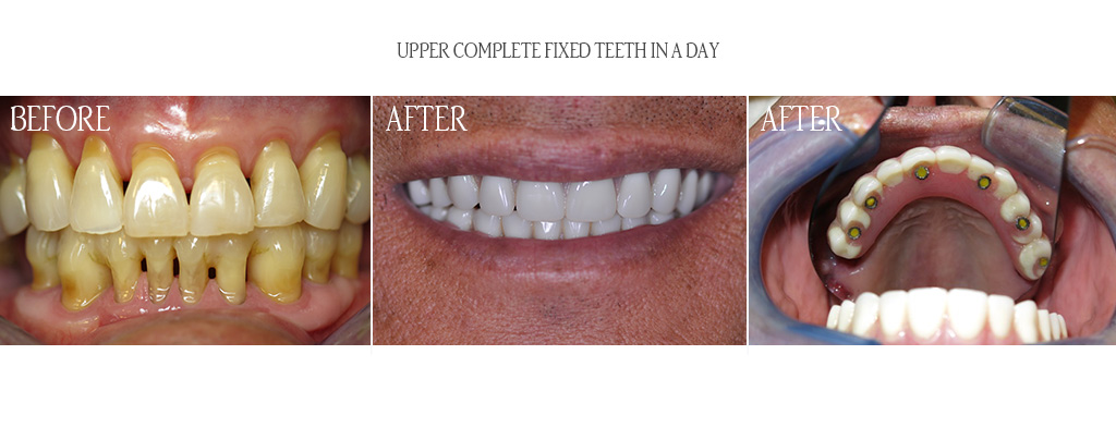 This is a five implant upper complete fixed prosthetic. This is a five implant upper complete fixed prosthetic.